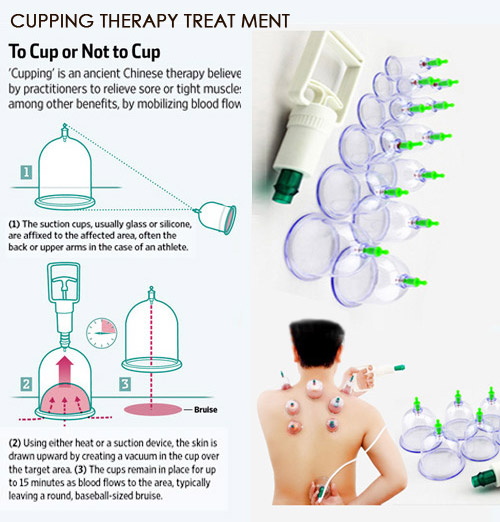 Shubh Surgical Rajkot Supplier of Health Care Cupping Therapy Body Massager Equpiment