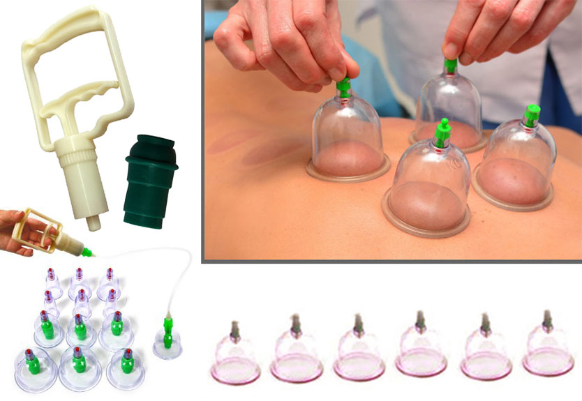Cupping Therapy Treatment